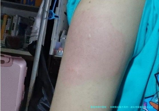 孕期胃反酸不再愁！超实用缓解攻略大公开