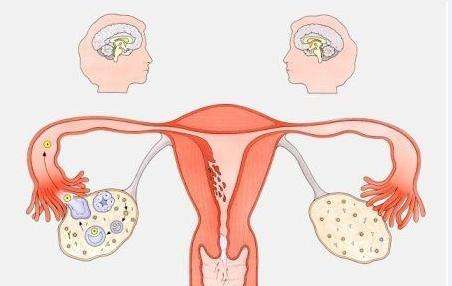 卵巢因素引发的不孕不育症