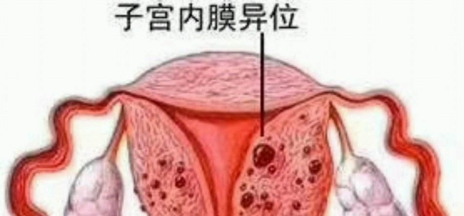 女性子宫内膜异位症