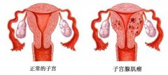 赴泰做试管婴儿子宫肌瘤会有什么影响？