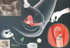 泰国和柬埔寨试管婴儿要移植多少个胚胎